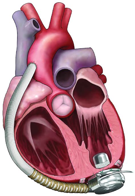 Jama cardiology - Long-term use of a left ventricular assist device for end-stage heart failure. N Engl J Med. 2001;345 (20):1435-1443. PubMed Google Scholar Crossref. Miller LW, Pagani FD, Russell SD, et al; HeartMate II Clinical Investigators. Use of a continuous-flow device in …